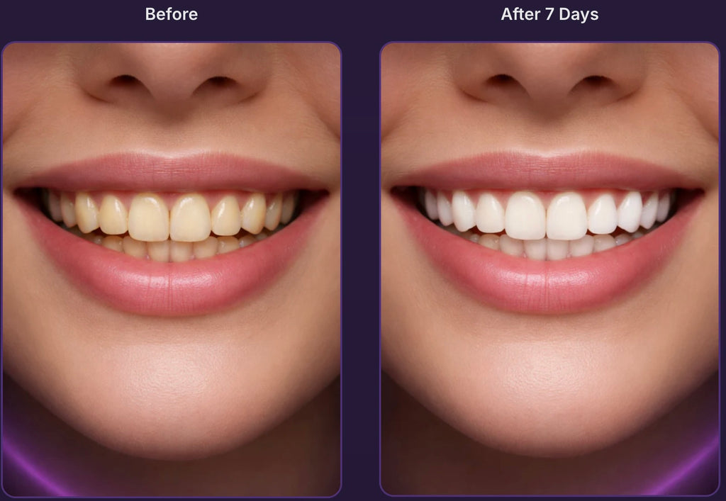 Ultravora Purple Whitening Teeth Strips